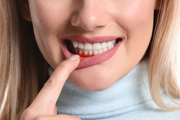 牙周病症狀：牙齦紅腫出血
