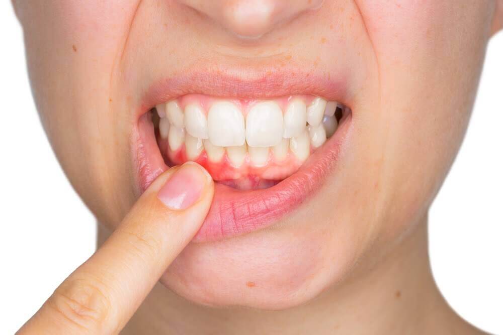 牙齦發炎怎麼辦？去洗牙