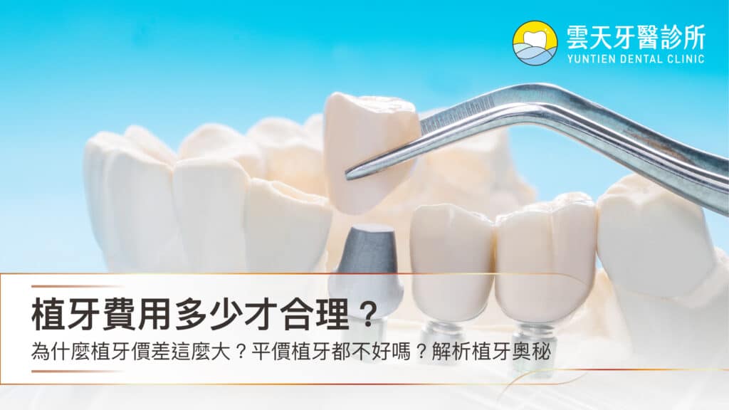 植牙費用多少才合理