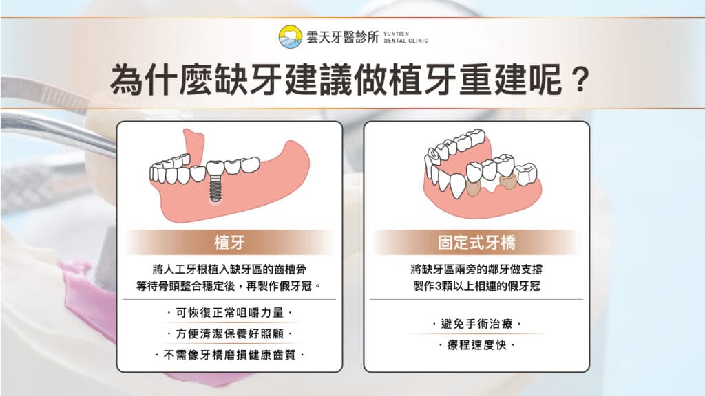缺牙就該做植牙嗎