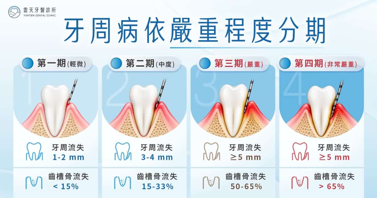 中重度牙周病,牙周囊袋已經偏深、骨頭流失範圍較大,就需要更完整的牙周統合治療